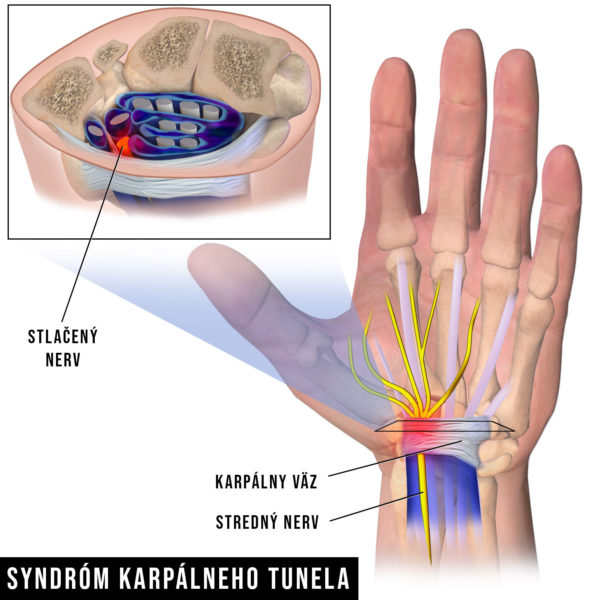 syndróm karpálneho tunela